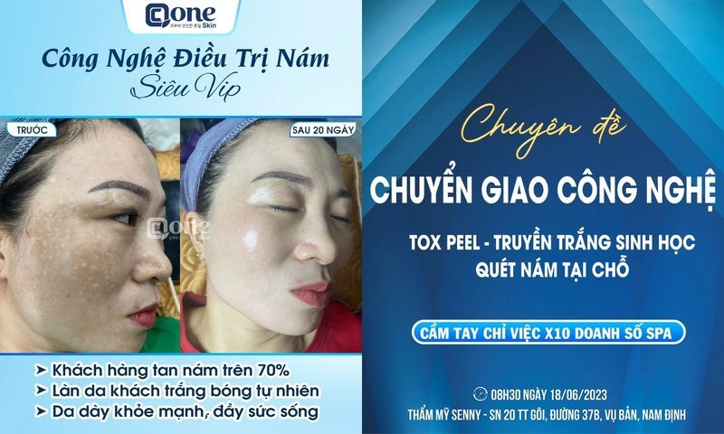 Chuyển giao công nghệ top peel